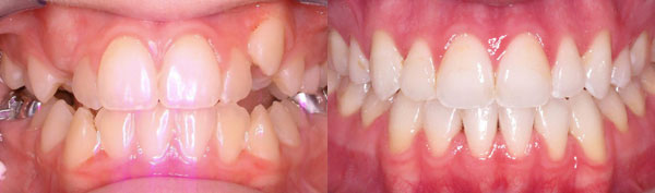 Teen Case: Braces