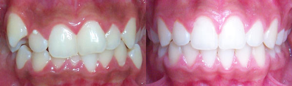 Teen Case: Braces