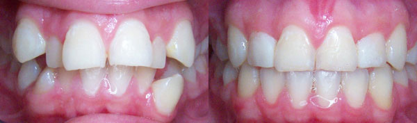 Teen Case: Braces
