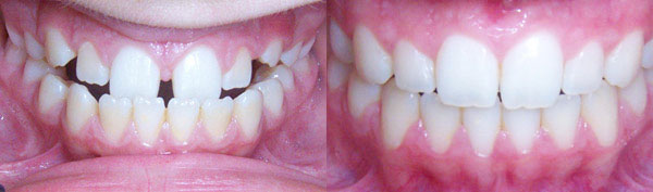Teen Case: Braces