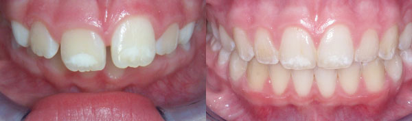 Teen Case: Braces