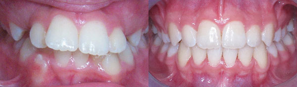 Teen Case: Herbst Appliance & Braces