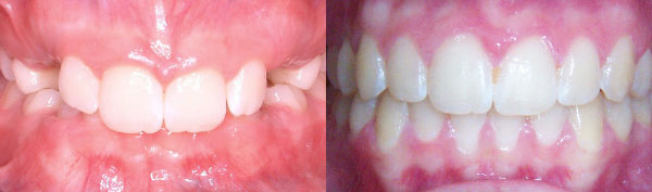 Teen Case: Braces