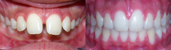 Teen Case: Braces