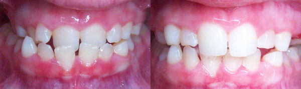 Pre-Teen: Expander Only
