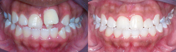 Teen Case: Braces