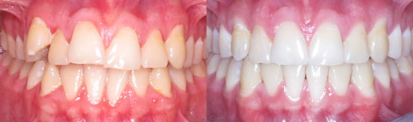 Teen Case: Invisalign
