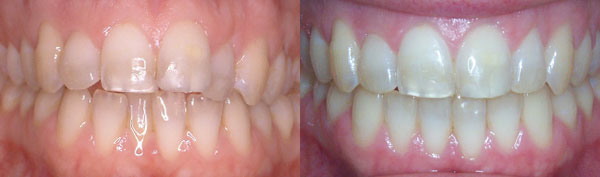 Adult Case: Invisalign