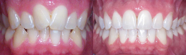 Adult Case: Invisalign