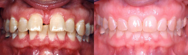 Adult Case: Invisalign