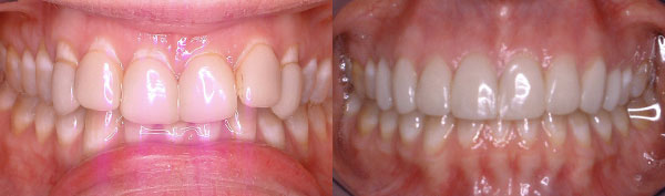 Adult Case: Partial Upper Braces