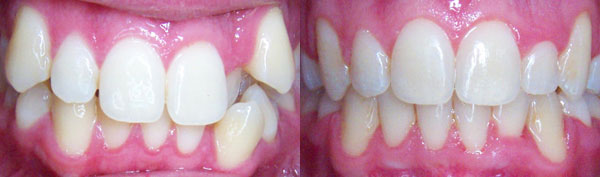 Adult Case: Braces