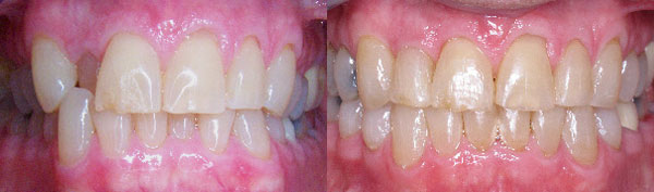 Adult Case: Braces