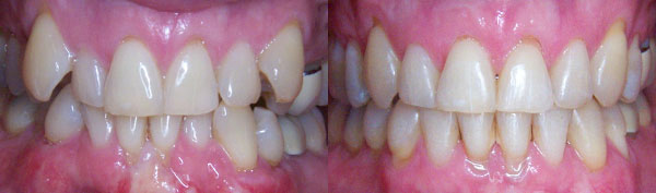 Adult Case: Braces