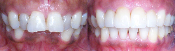 Adult Case: Braces