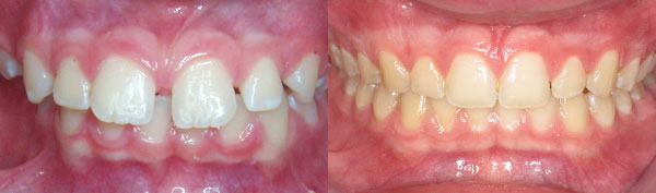 Special Needs Teen: Braces
