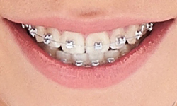 metal braces